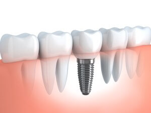 Clínica dental Badalona implantes dentales