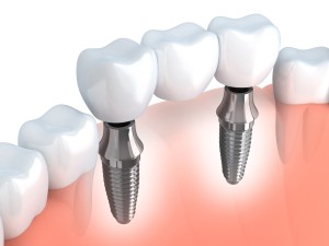 Implantes dentales Badalona